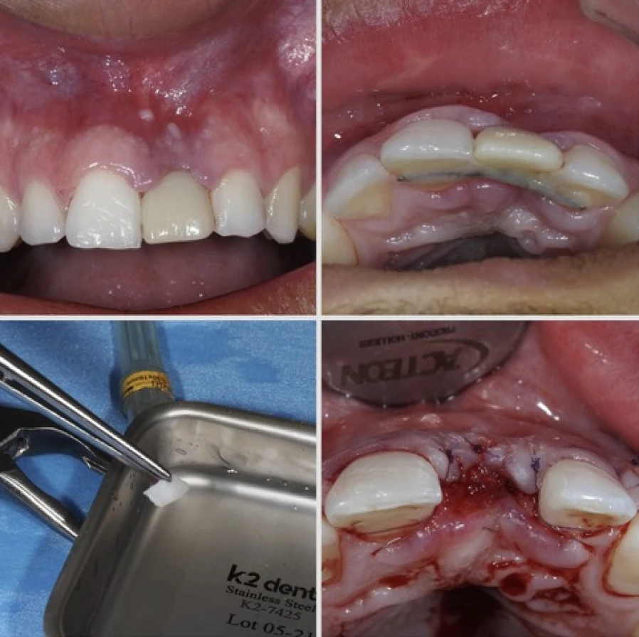 Greffe conjonctive réalisée après traumatisme dentaire avec perte d’incisive en vue d’un bridge cantilever à Apolline Dental Care à Corbeil-Essonnes