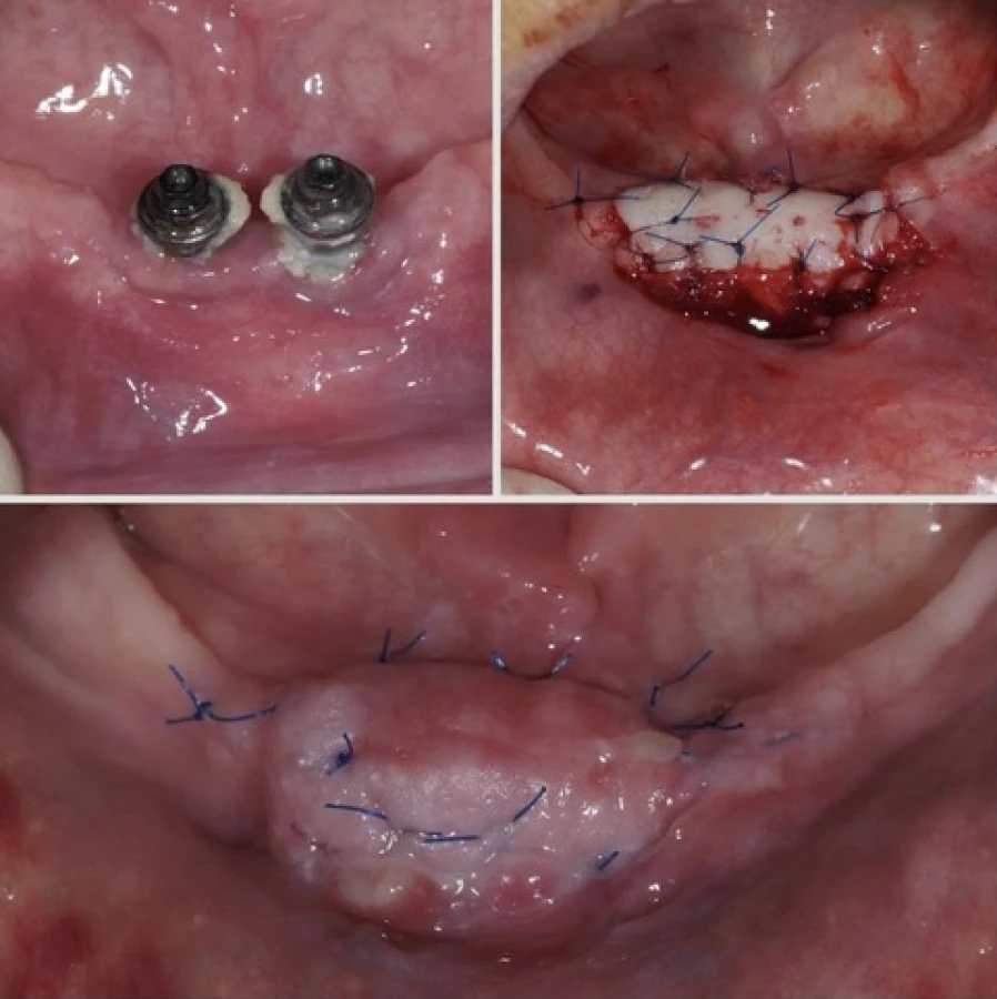 Greffe de gencive réalisée après péri-implantite sur un ancien implant chez une personne âgée à Apolline Dental Care à Corbeil-Essonnes