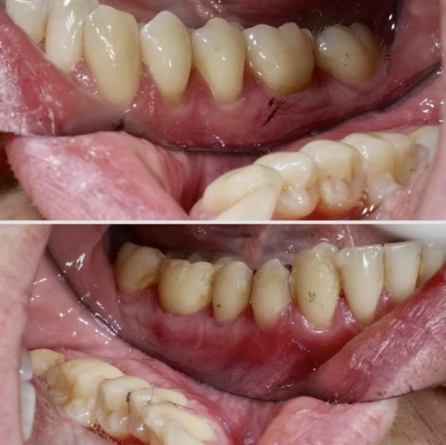 Lambeau tracté avec greffe conjonctive pour traiter la sensibilité dentaire liée à la récession gingivale à Apolline Dental Care à Corbeil-Essonnes
