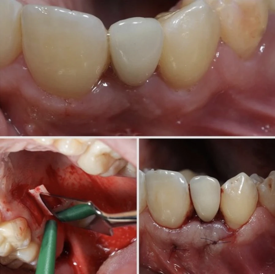 greffe conjonctive Bridge Collé Cantilver Posterieur Dentistes Essonne | Apolline Dental Care