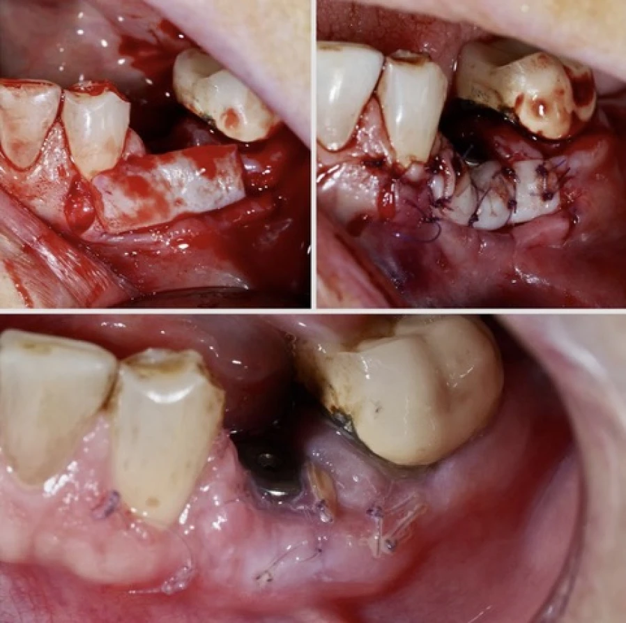 greffe conjonctive2 Bridge Collé Cantilver Posterieur Dentistes Essonne | Apolline Dental Care