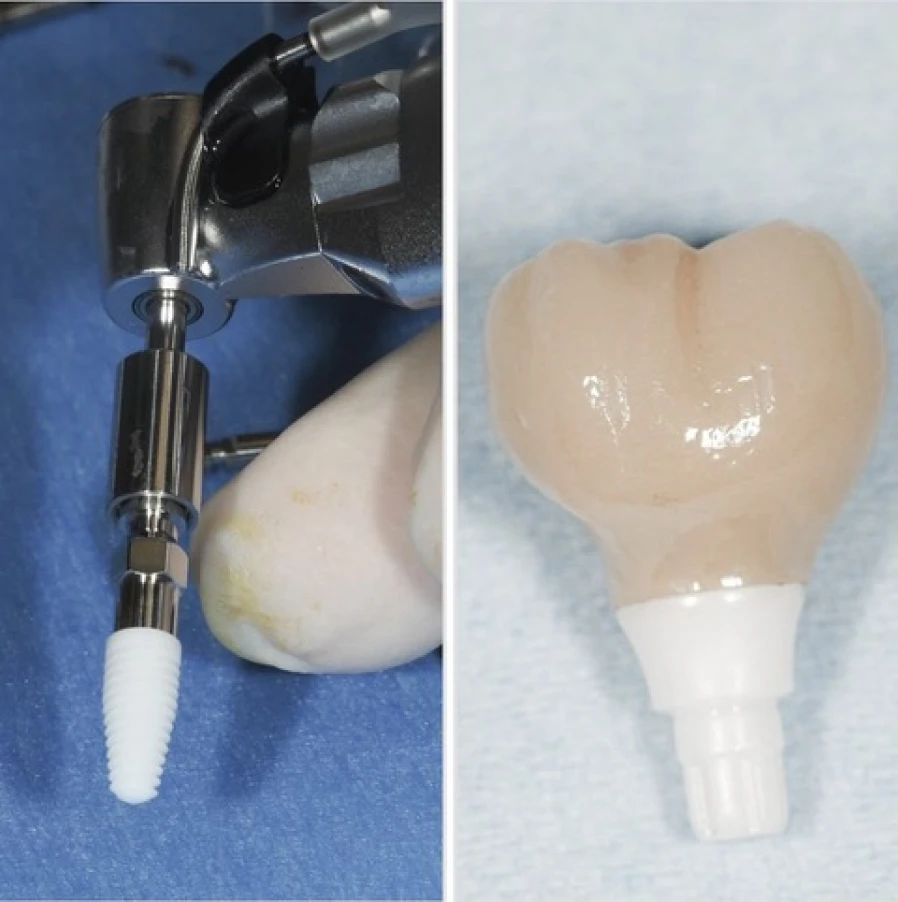 implant zircone Bridge Collé Cantilver Posterieur Dentistes Essonne | Apolline Dental Care
