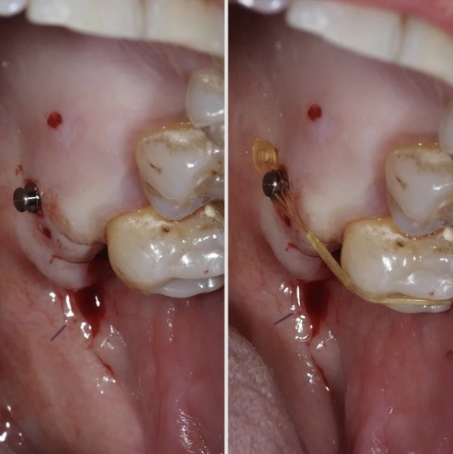 ingression Bridge Collé Cantilver Posterieur Dentistes Essonne | Apolline Dental Care