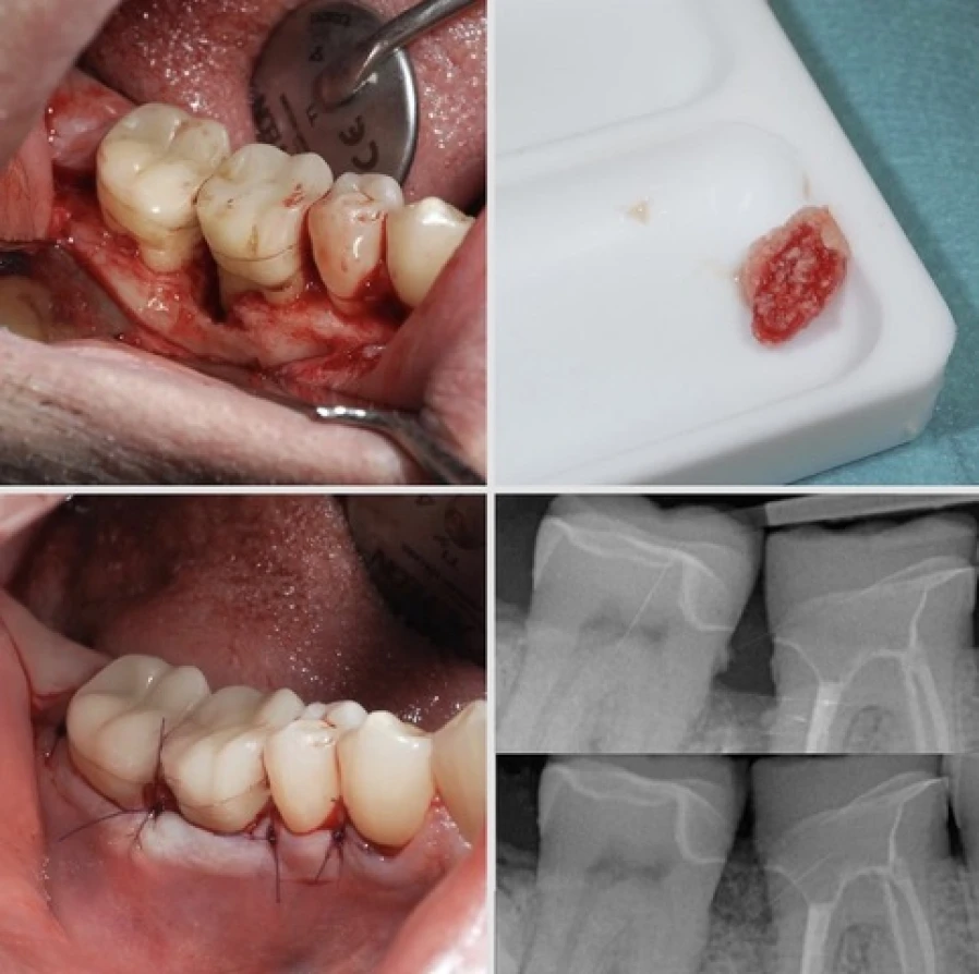lesion intraosseuse Bridge Collé Cantilver Posterieur Dentistes Essonne | Apolline Dental Care