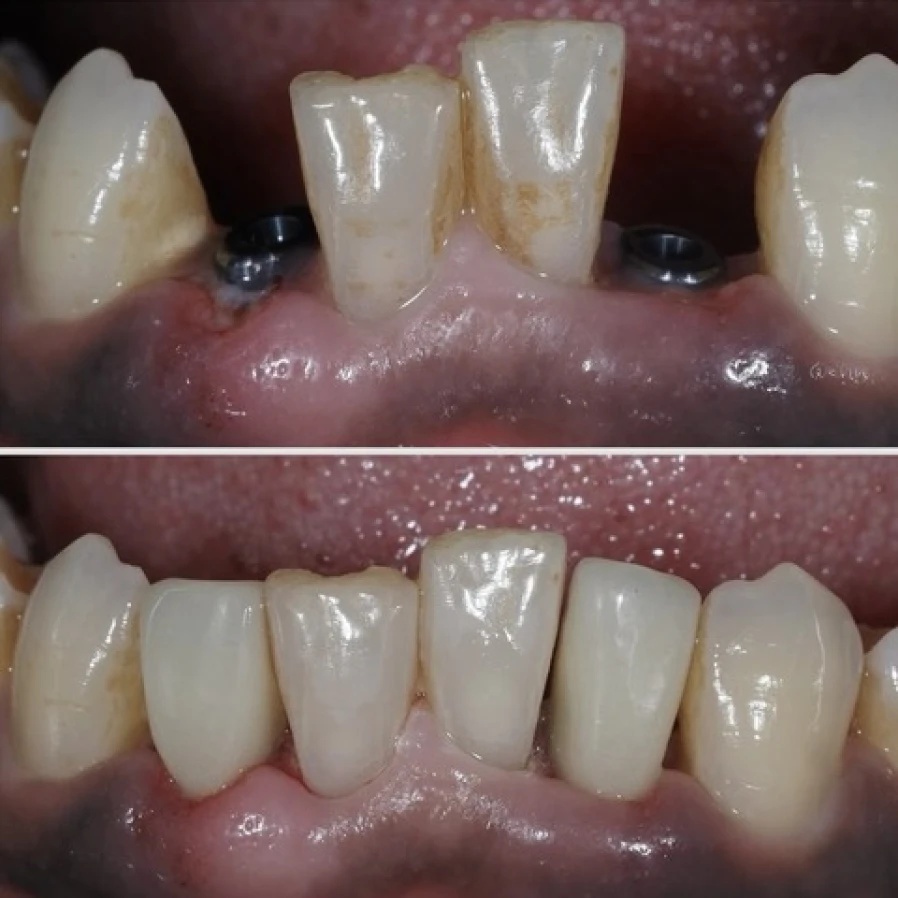 mei 2 Bridge Collé Cantilver Posterieur Dentistes Essonne | Apolline Dental Care