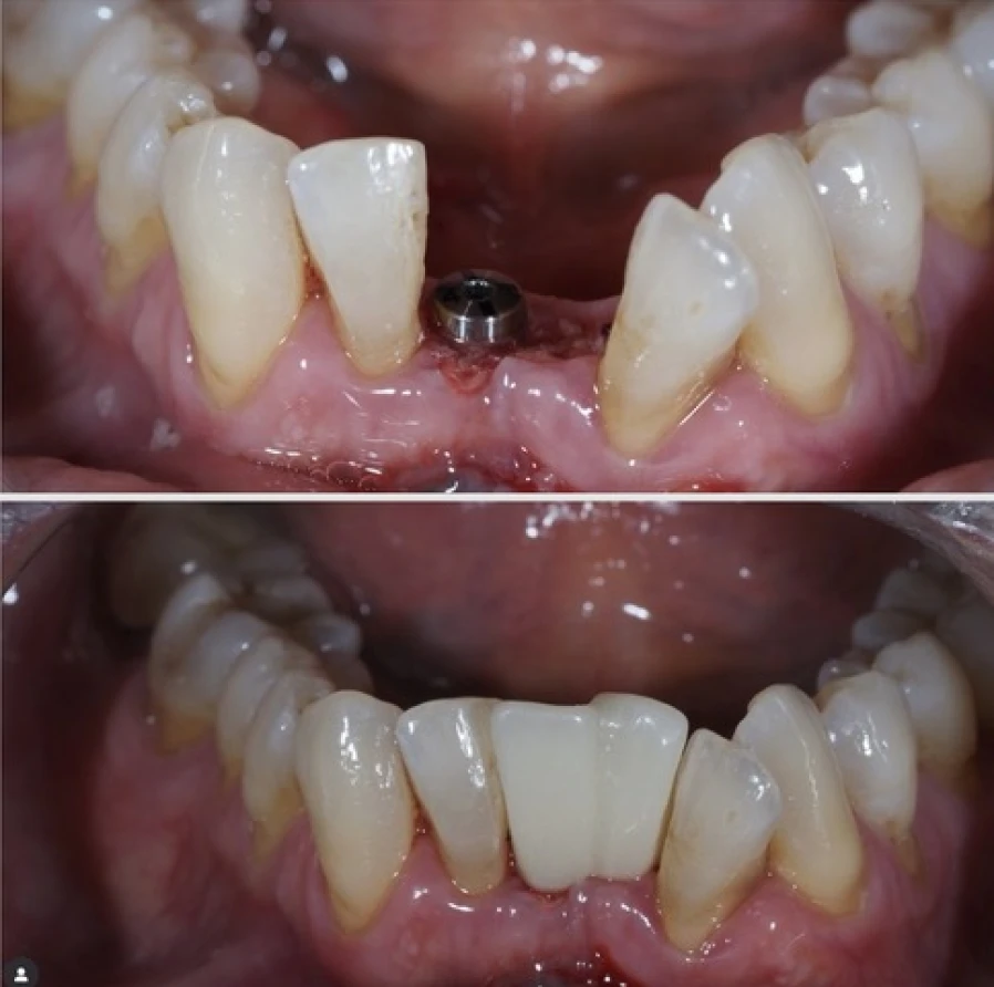 mei 3 Bridge Collé Cantilver Posterieur Dentistes Essonne | Apolline Dental Care