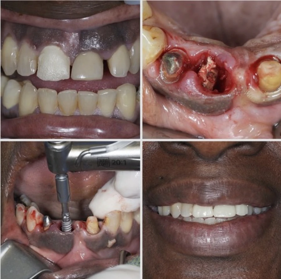 mei 4 Bridge Collé Cantilver Posterieur Dentistes Essonne | Apolline Dental Care
