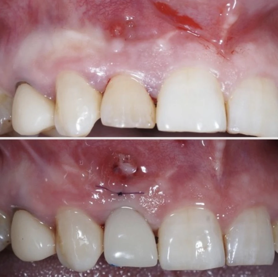 mei 5 Bridge Collé Cantilver Posterieur Dentistes Essonne | Apolline Dental Care