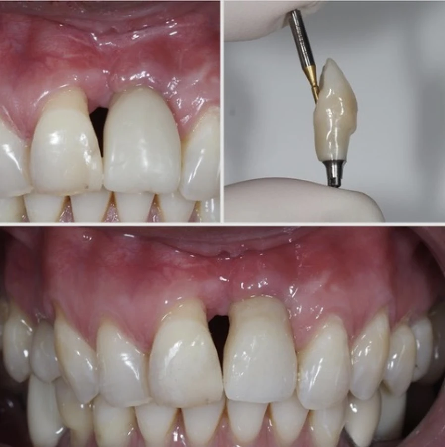 mei 6 Bridge Collé Cantilver Posterieur Dentistes Essonne | Apolline Dental Care
