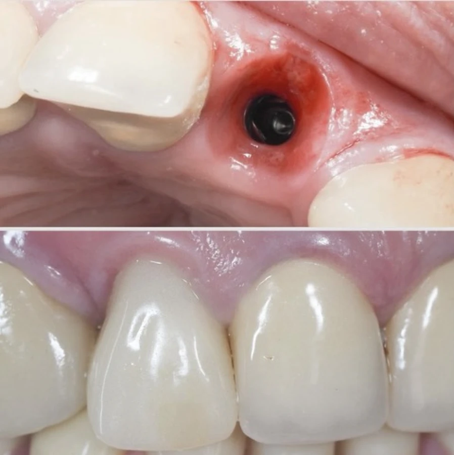 mei Bridge Collé Cantilver Posterieur Dentistes Essonne | Apolline Dental Care