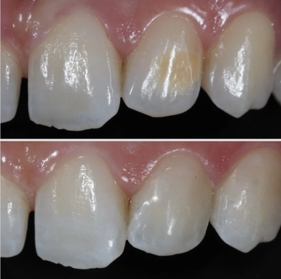 mih 2 Bridge Collé Cantilver Posterieur Dentistes Essonne | Apolline Dental Care