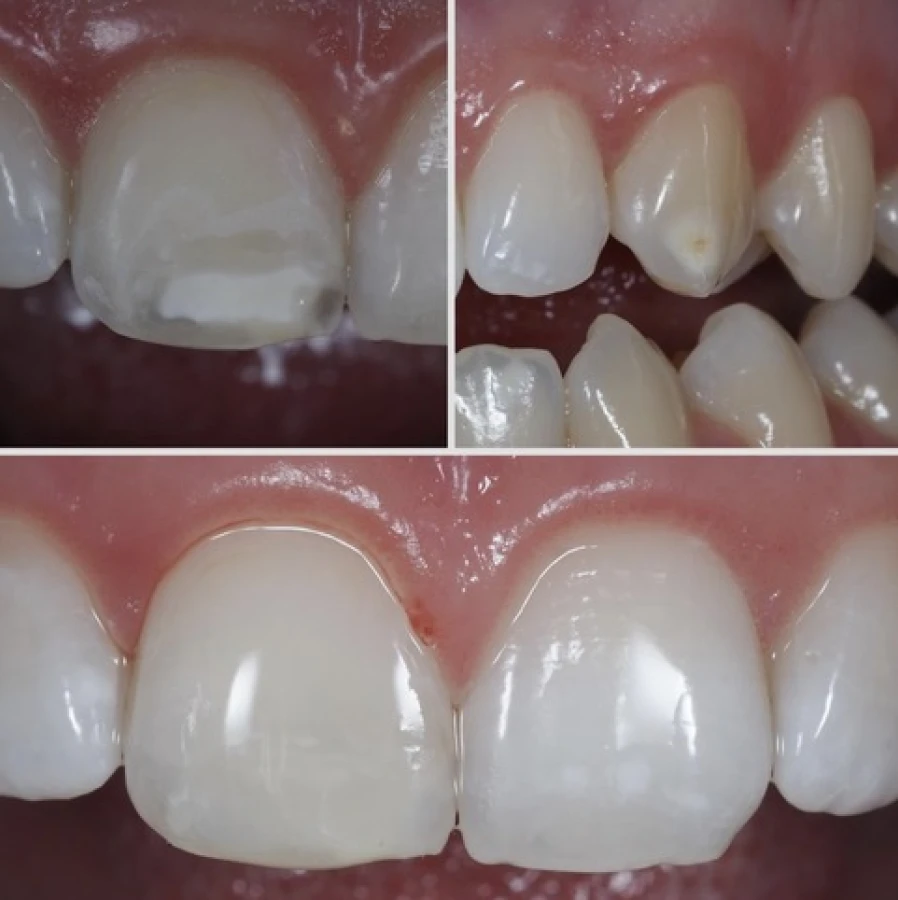 mih Bridge Collé Cantilver Posterieur Dentistes Essonne | Apolline Dental Care