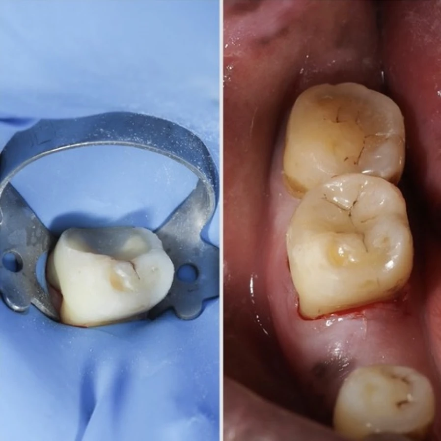 onlay Bridge Collé Cantilver Posterieur Dentistes Essonne | Apolline Dental Care