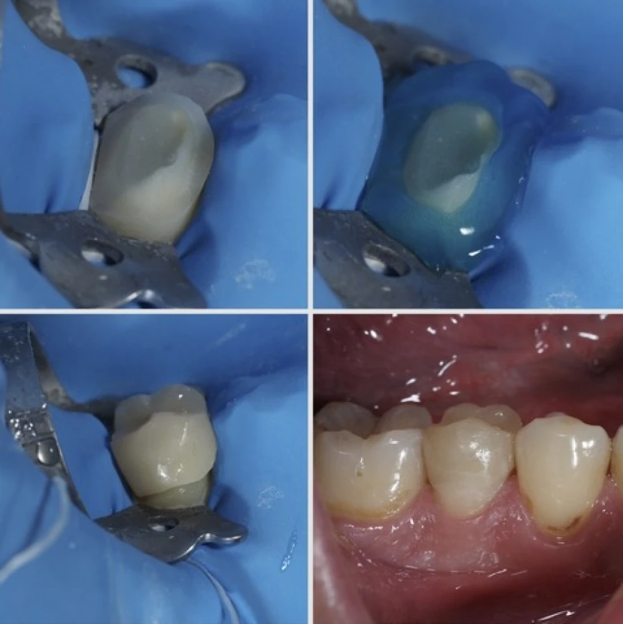 onlay3 Bridge Collé Cantilver Posterieur Dentistes Essonne | Apolline Dental Care