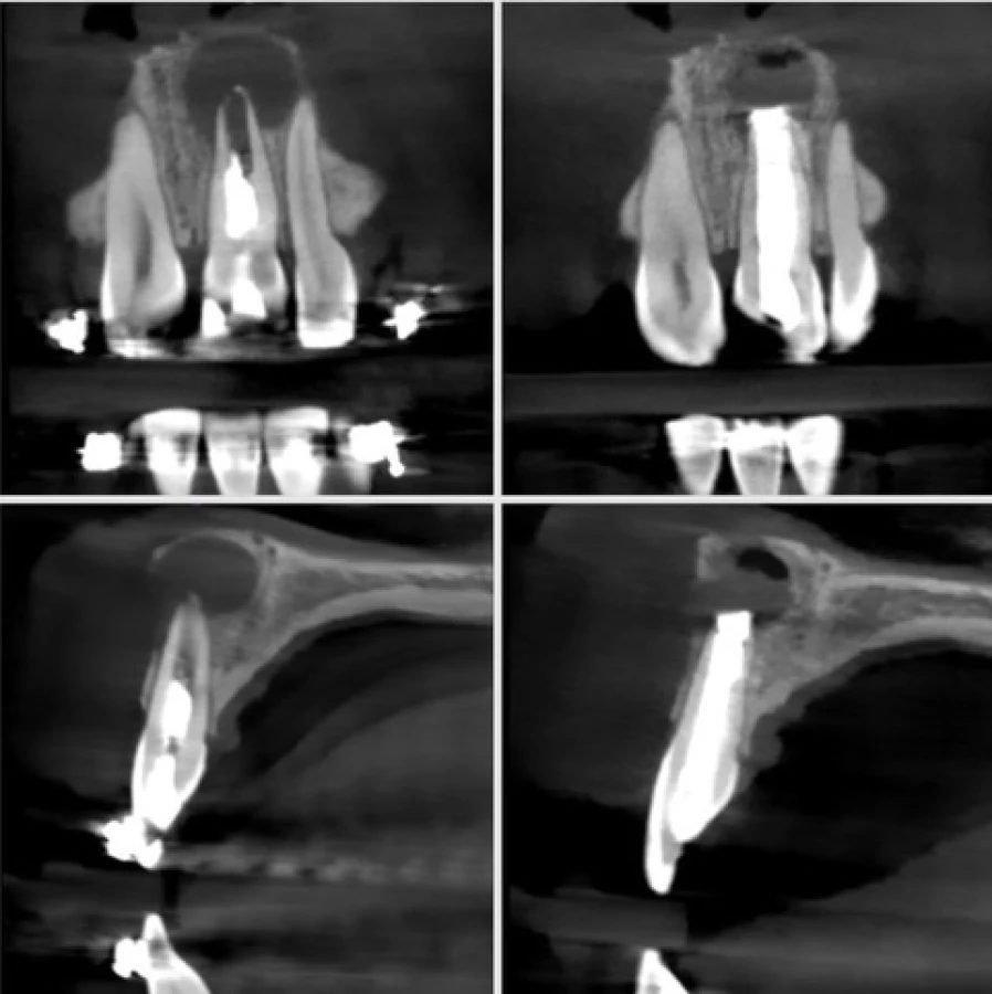 resection apical 2 Bridge Collé Cantilver Posterieur Dentistes Essonne | Apolline Dental Care