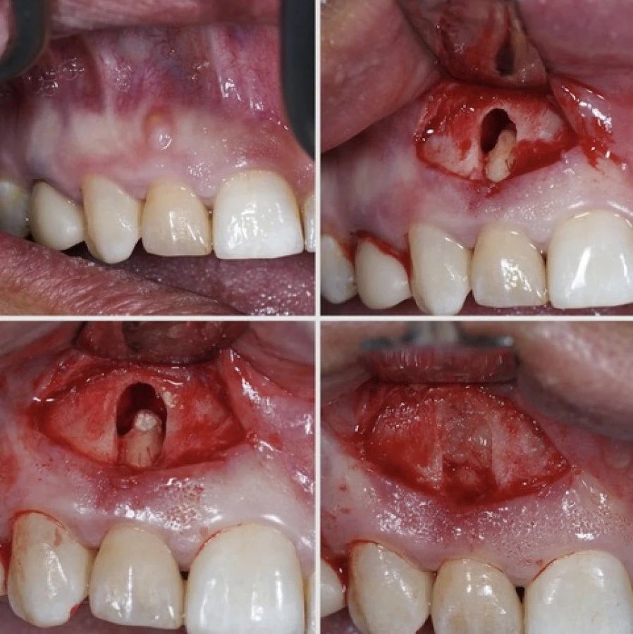 resection apical Bridge Collé Cantilver Posterieur Dentistes Essonne | Apolline Dental Care