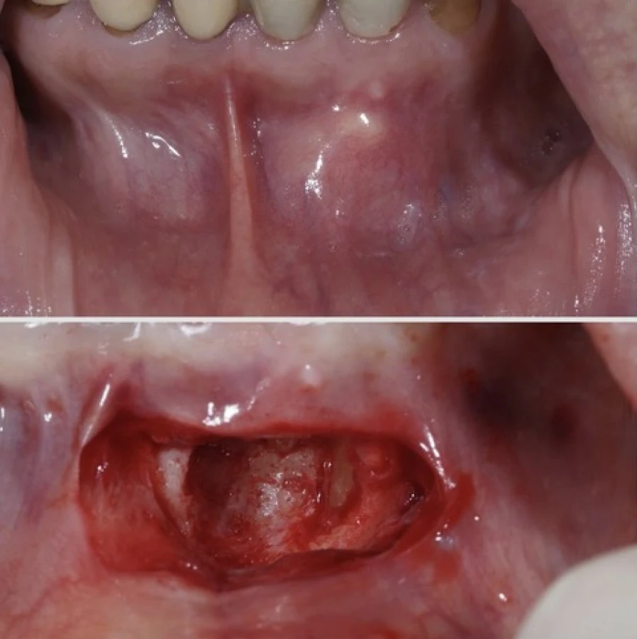 resection apical3 Bridge Collé Cantilver Posterieur Dentistes Essonne | Apolline Dental Care