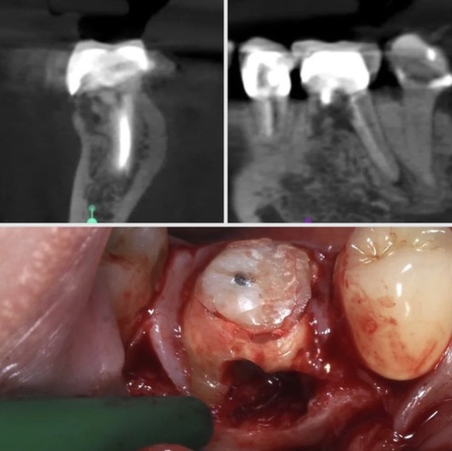 resoption Bridge Collé Cantilver Posterieur Dentistes Essonne | Apolline Dental Care