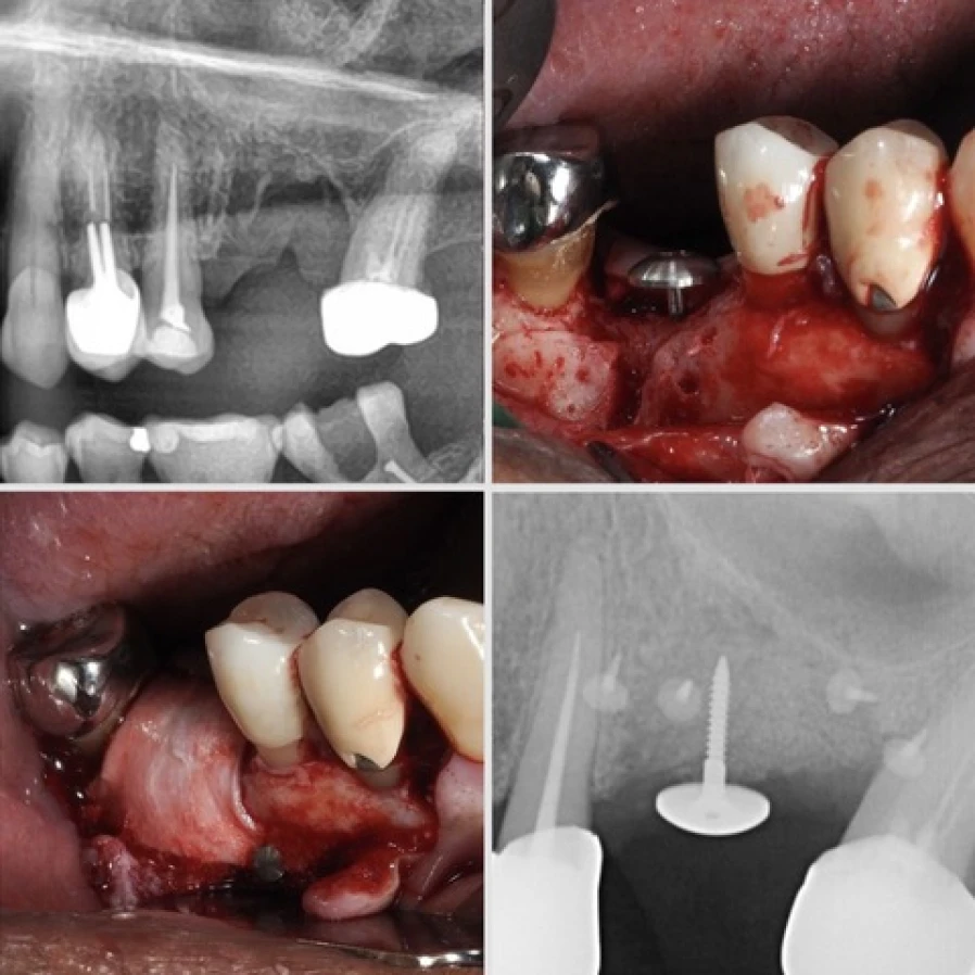 rog 2 Bridge Collé Cantilver Posterieur Dentistes Essonne | Apolline Dental Care