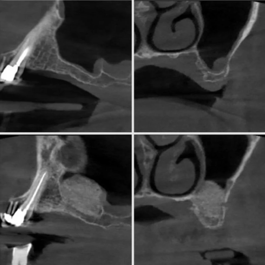 sinus 2 Bridge Collé Cantilver Posterieur Dentistes Essonne | Apolline Dental Care