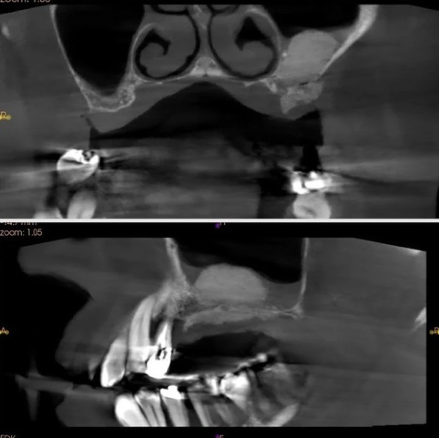 sinus 3 Bridge Collé Cantilver Posterieur Dentistes Essonne | Apolline Dental Care
