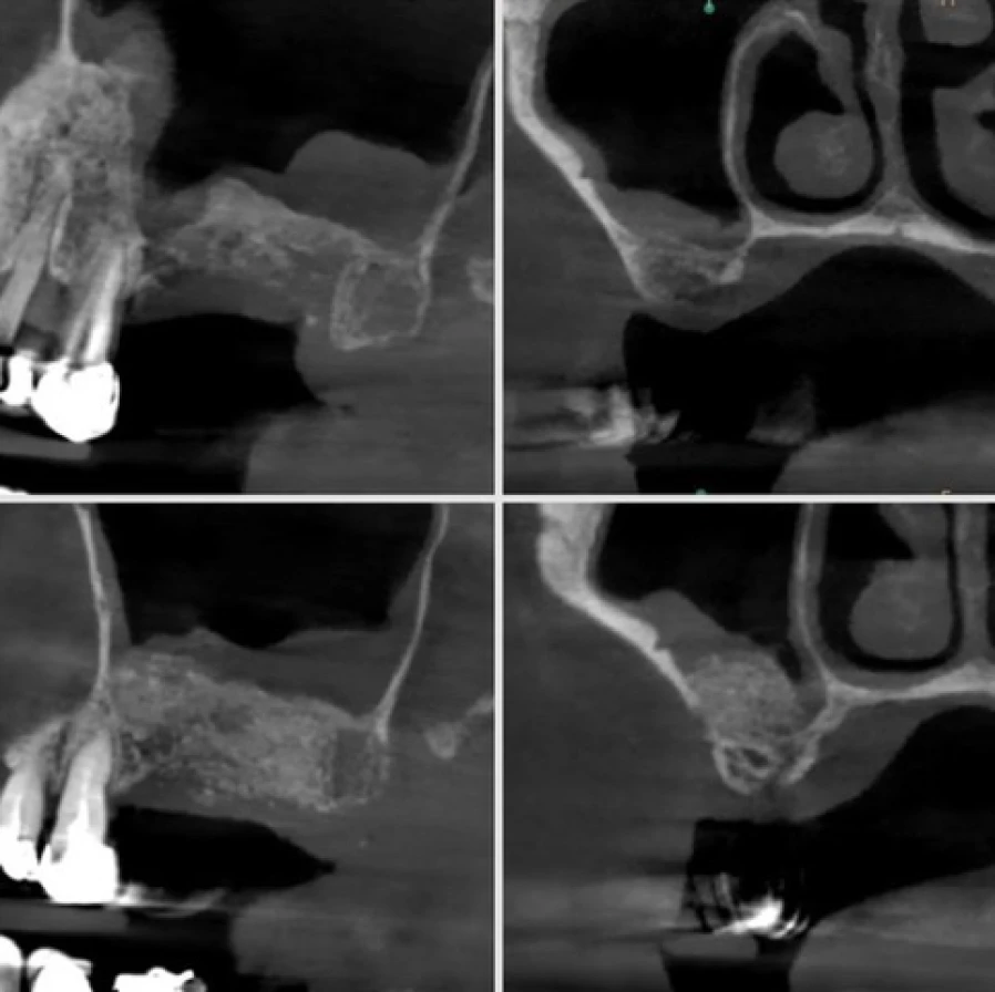 sinus Bridge Collé Cantilver Posterieur Dentistes Essonne | Apolline Dental Care