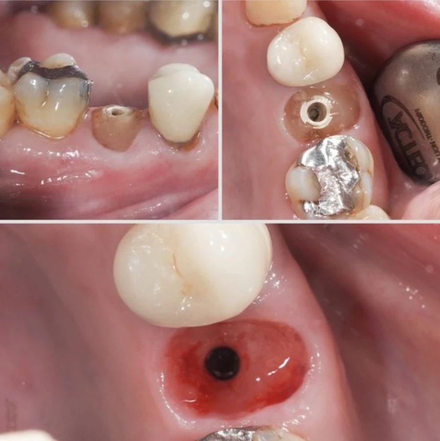 ssa Bridge Collé Cantilver Posterieur Dentistes Essonne | Apolline Dental Care