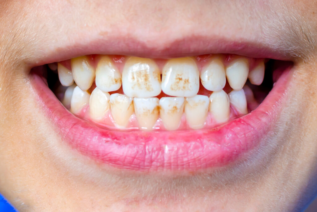 dark plaque on children s teeth priestley s raid dental health concept oral care pediatric dentistry and periodontology dark spots on teeth Soins parodontaux Dentistes Essonne | Apolline Dental Care