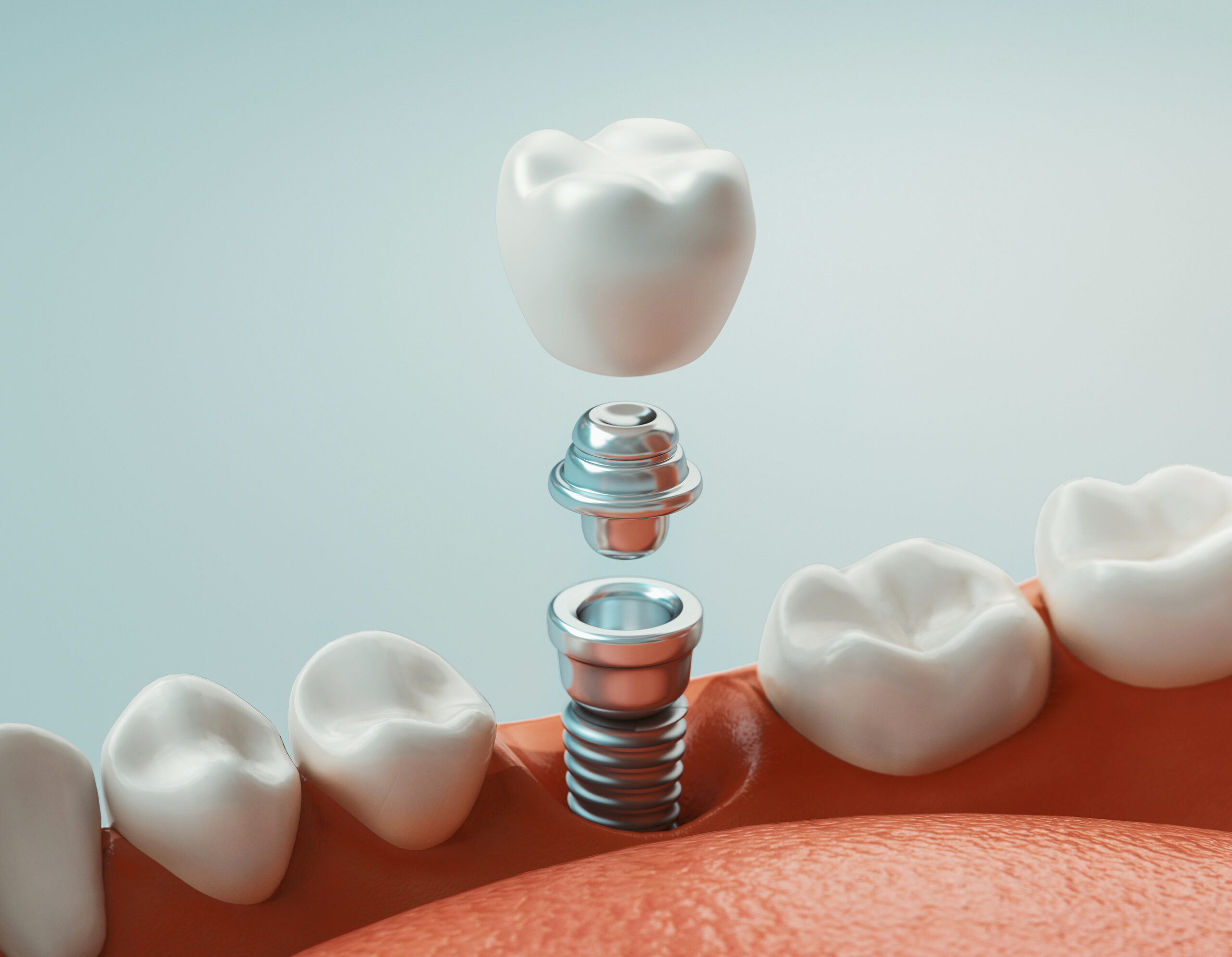 Implant dentaire conçu pour remplacer la racine d’une dent manquante et restaurer la fonction naturelle à Apolline Dental Care à Corbeil-Essonnes