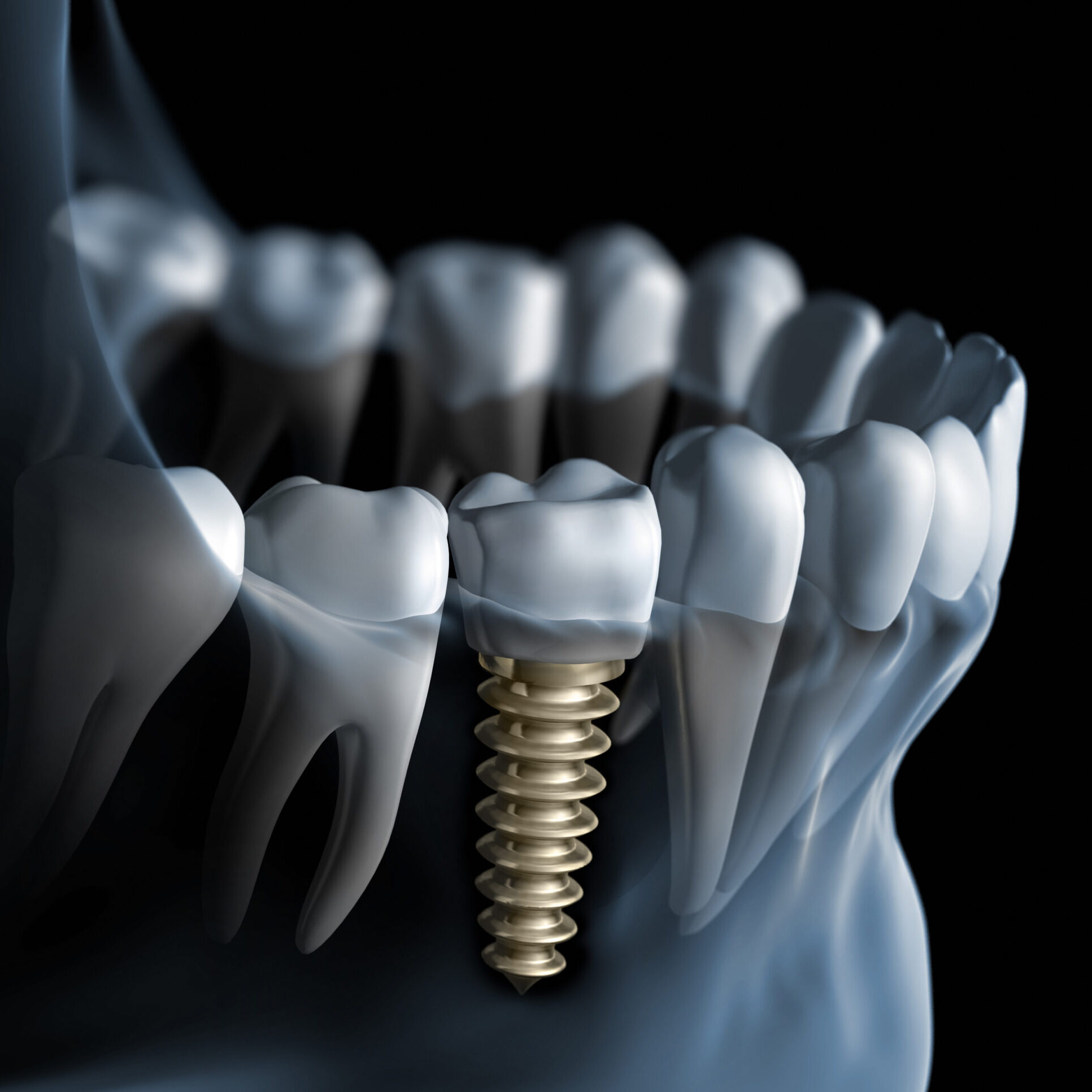 Implant dentaire utilisé pour préserver l’os et restaurer la fonction masticatoire à Apolline Dental Care à Corbeil-Essonnes