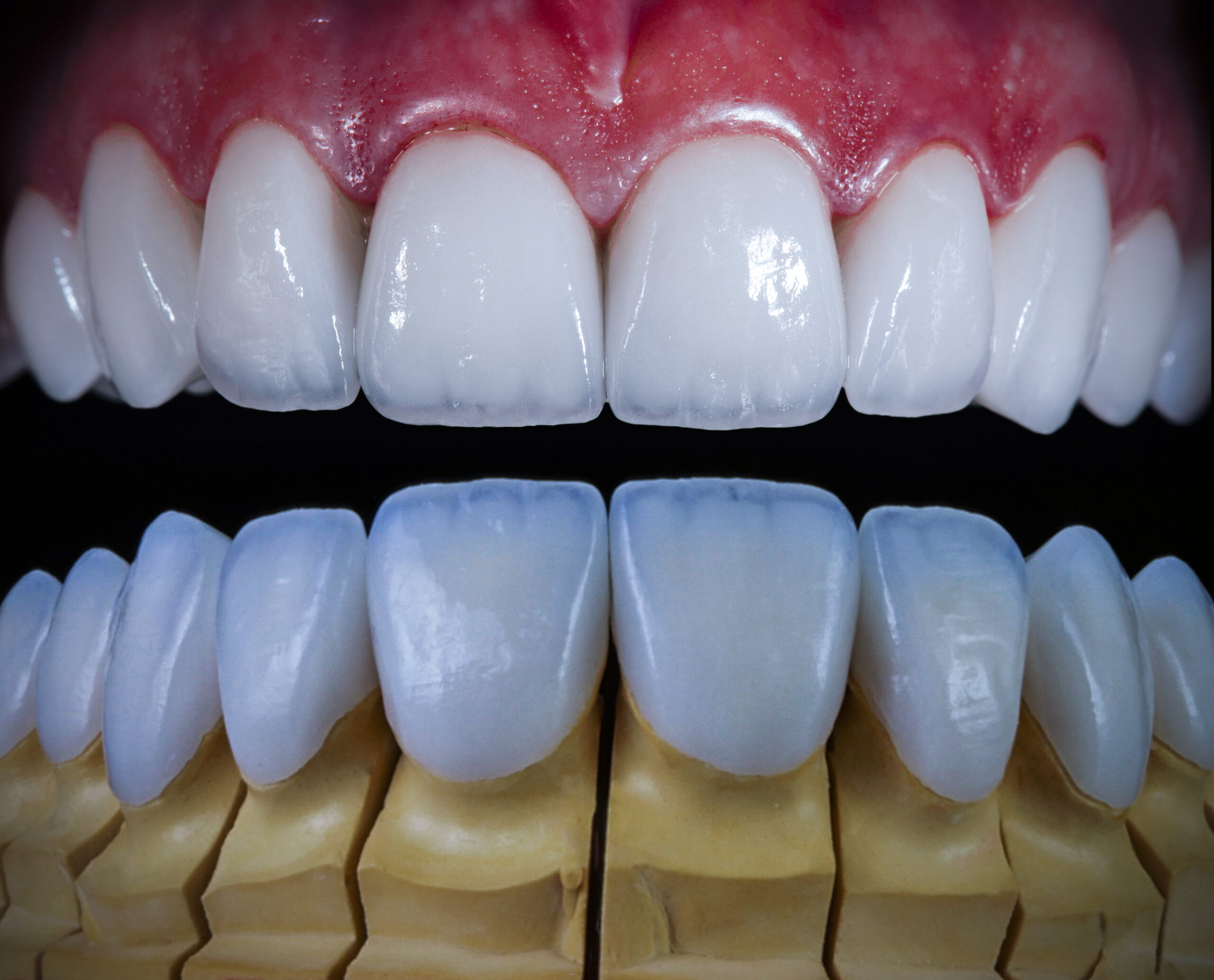 Couronne céramique posée pour restaurer une dent tout en conservant une esthétique naturelle à Apolline Dental Care à Corbeil-Essonnes