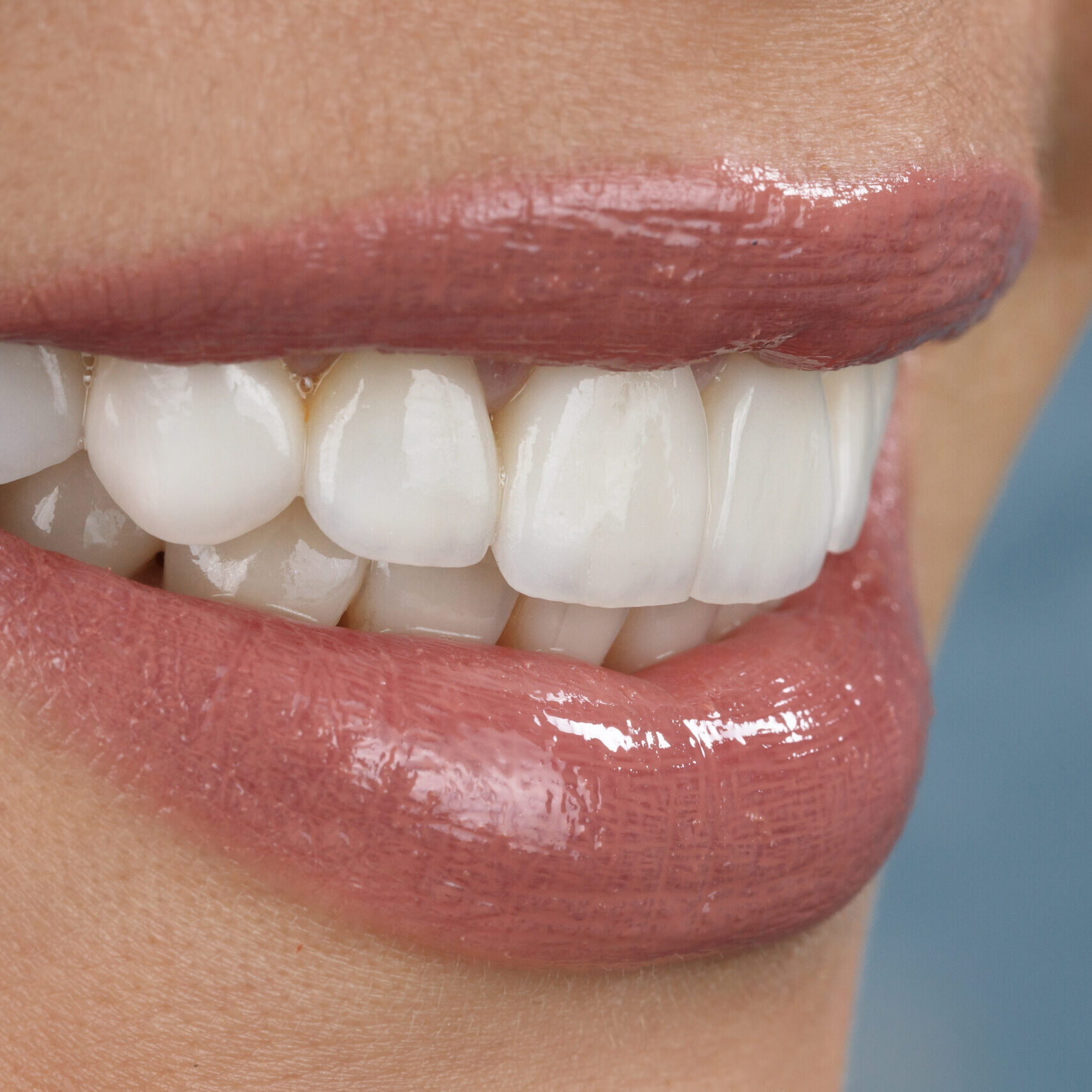 Transformation esthétique du sourire par facettes dentaires associées à un éclaircissement à Apolline Dental Care à Corbeil-Essonnes