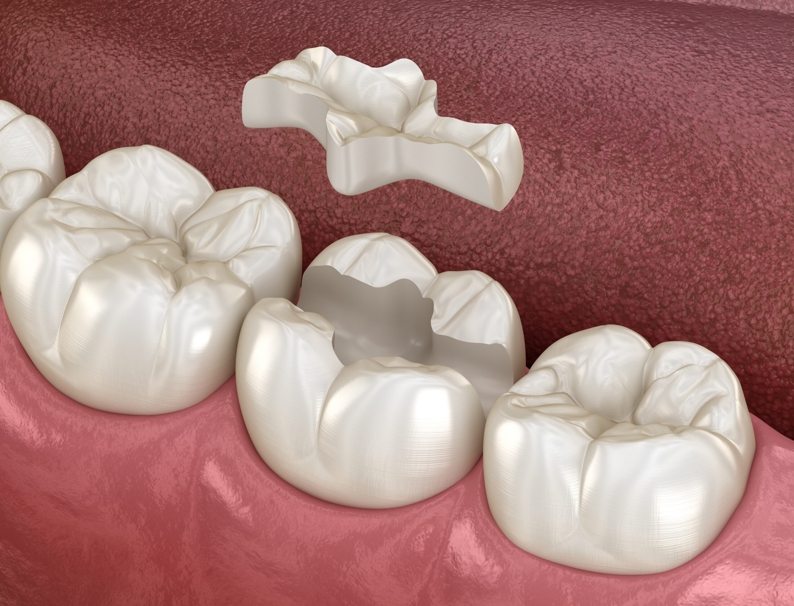 Onlay céramique fabriqué grâce à la technologie numérique CFAO et posé en une seule séance à Apolline Dental Care à Corbeil-Essonnes