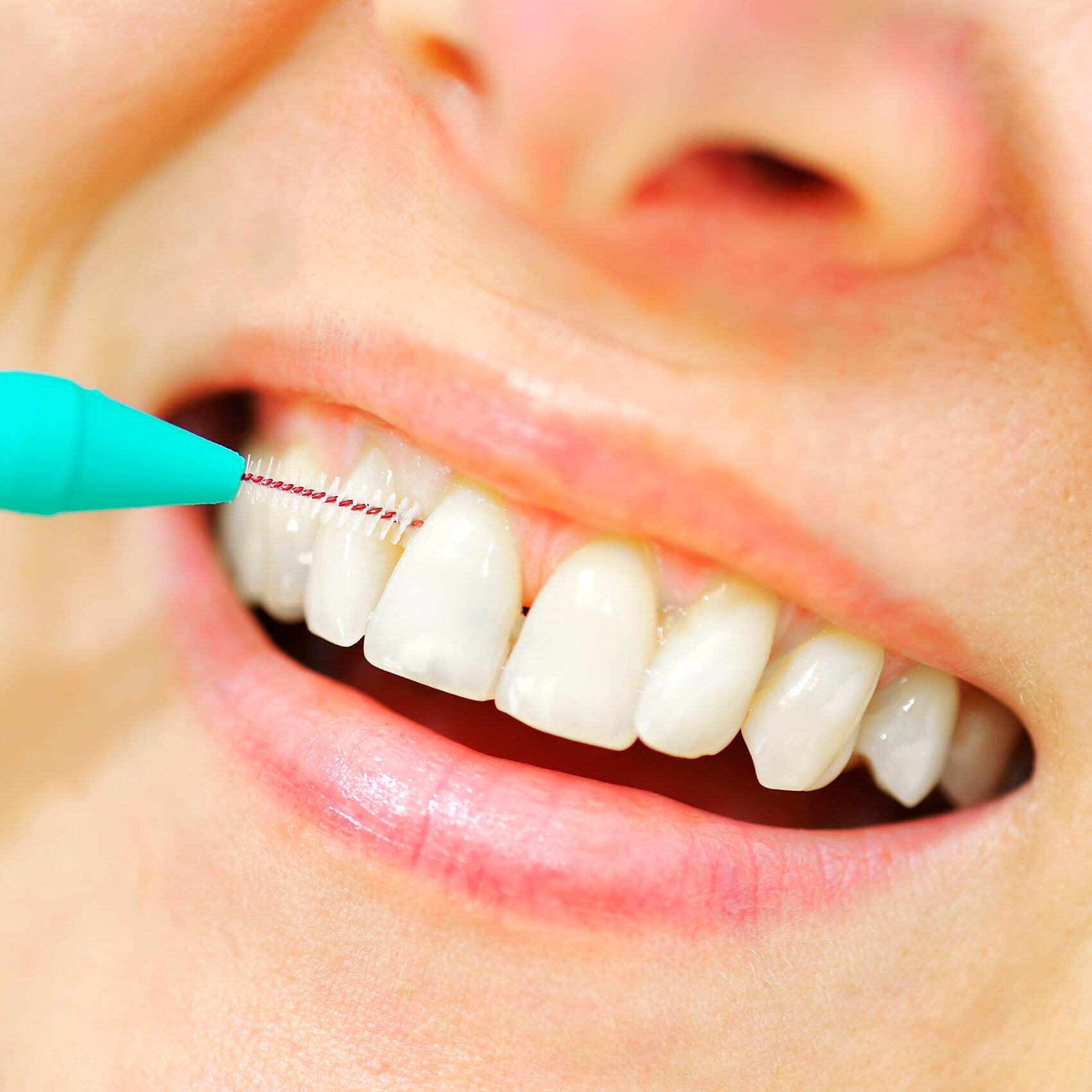 Brossette interdentaire utilisée pour nettoyer les espaces interdentaires et prévenir l’inflammation des gencives à Apolline Dental Care à Corbeil-Essonnes