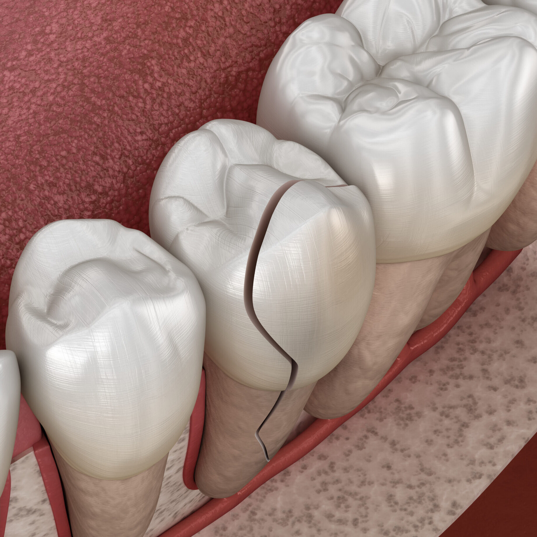 Dent dévitalisée fracturée nécessitant une restauration conservatrice à Apolline Dental Care à Corbeil-Essonnes