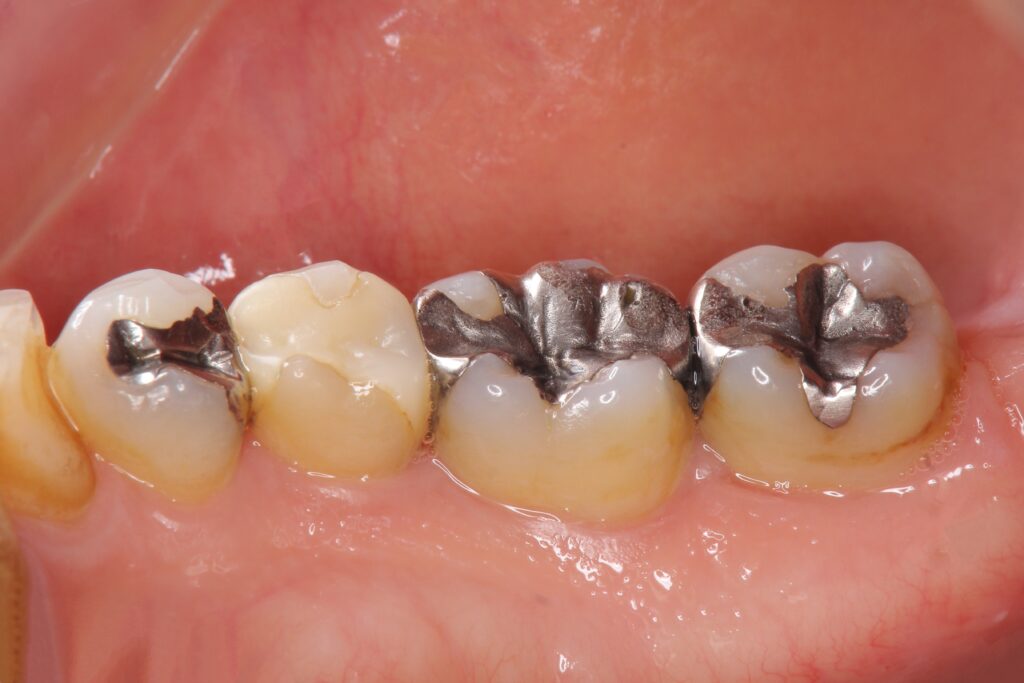 adobestock 345686567 1024x683 Onlay dentaire céramique Dentistes Essonne | Apolline Dental Care