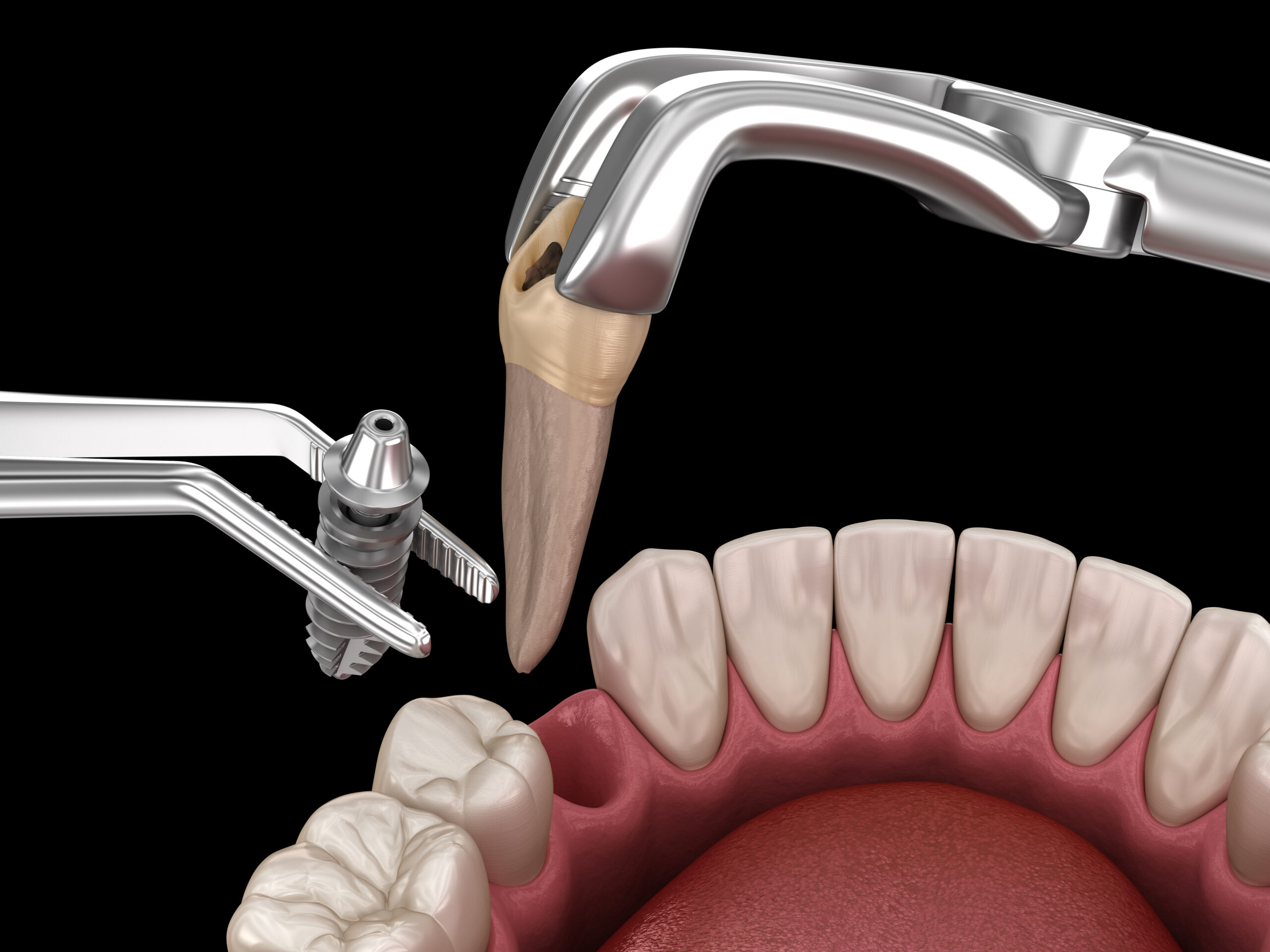 Extraction dentaire simple réalisée sous anesthésie locale à Apolline Dental Care à Corbeil-Essonnes