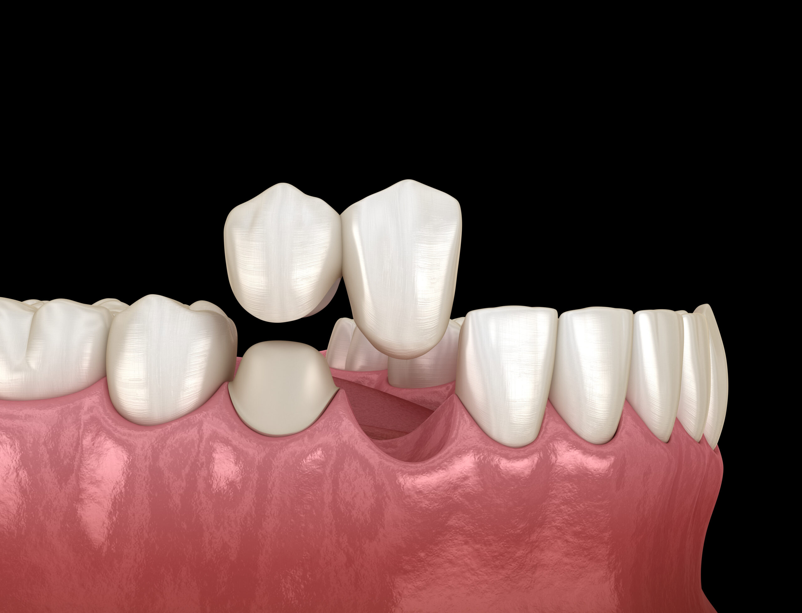 Bridge cantilever utilisé pour remplacer une dent manquante tout en préservant les dents adjacentes à Apolline Dental Care à Corbeil-Essonnes