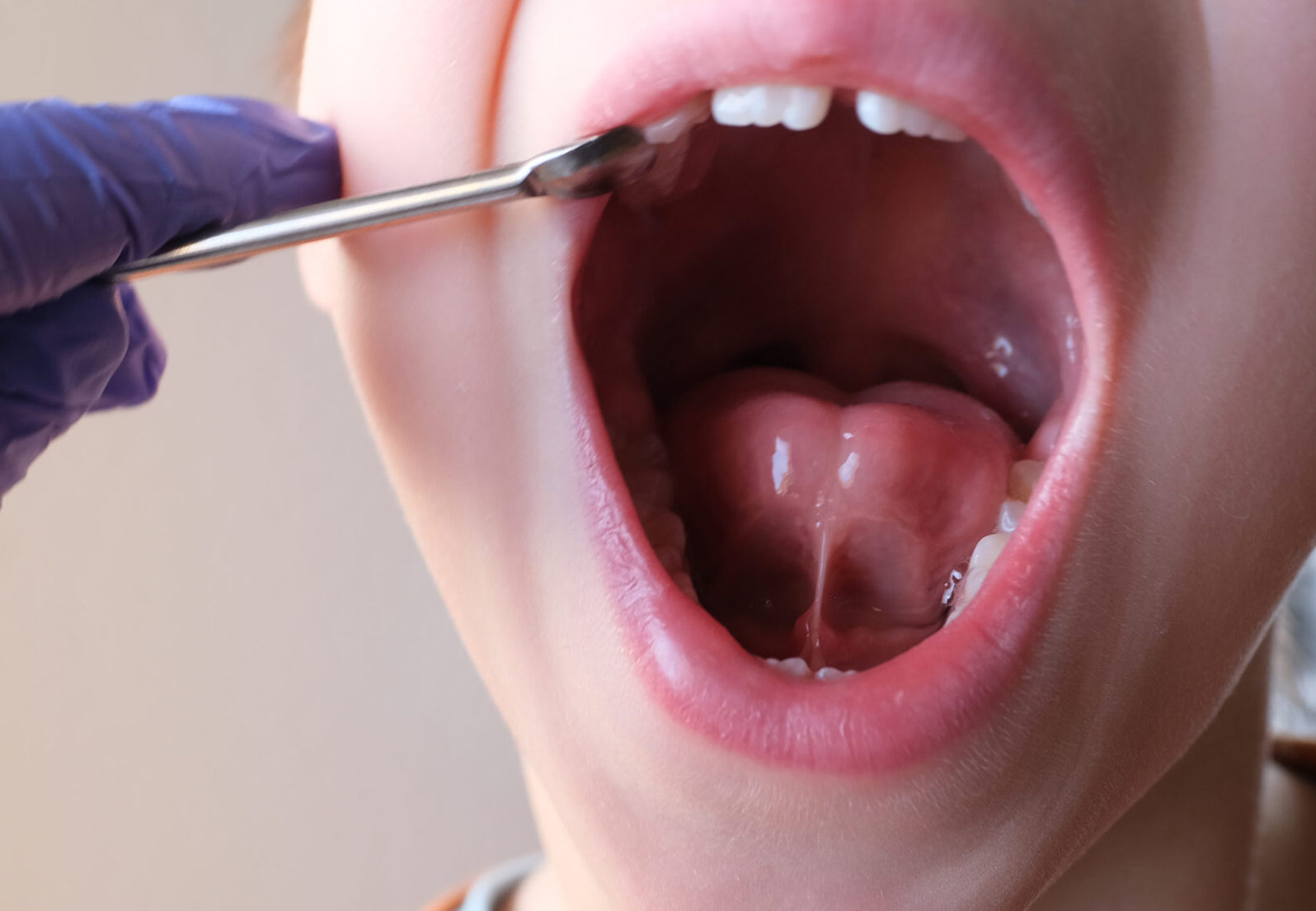 Frénectomie réalisée pour corriger un frein lingual ou labial restrictif à Apolline Dental Care à Corbeil-Essonnes