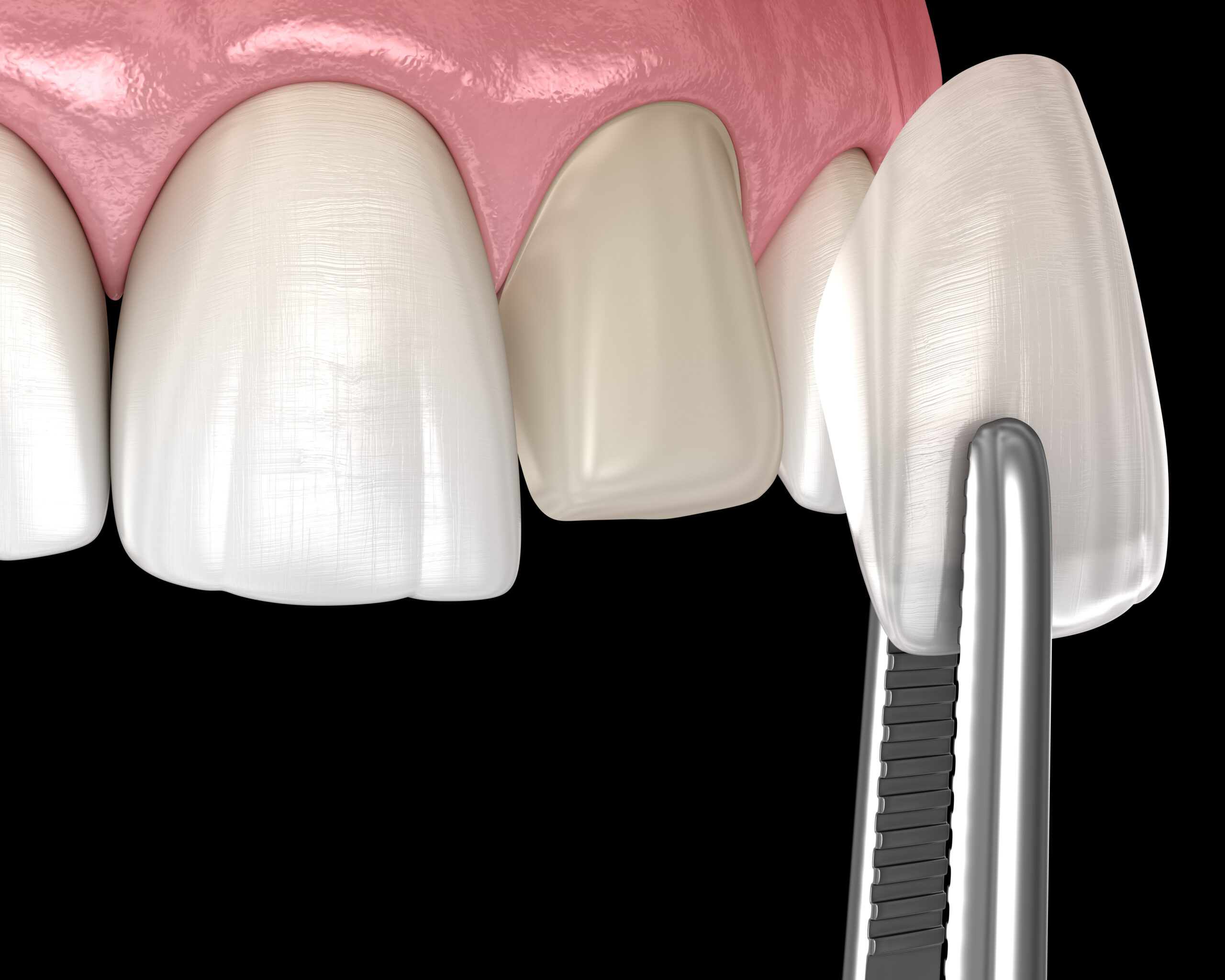 Facette dentaire esthétique posée pour transformer le sourire à Apolline Dental Care à Corbeil-Essonnes