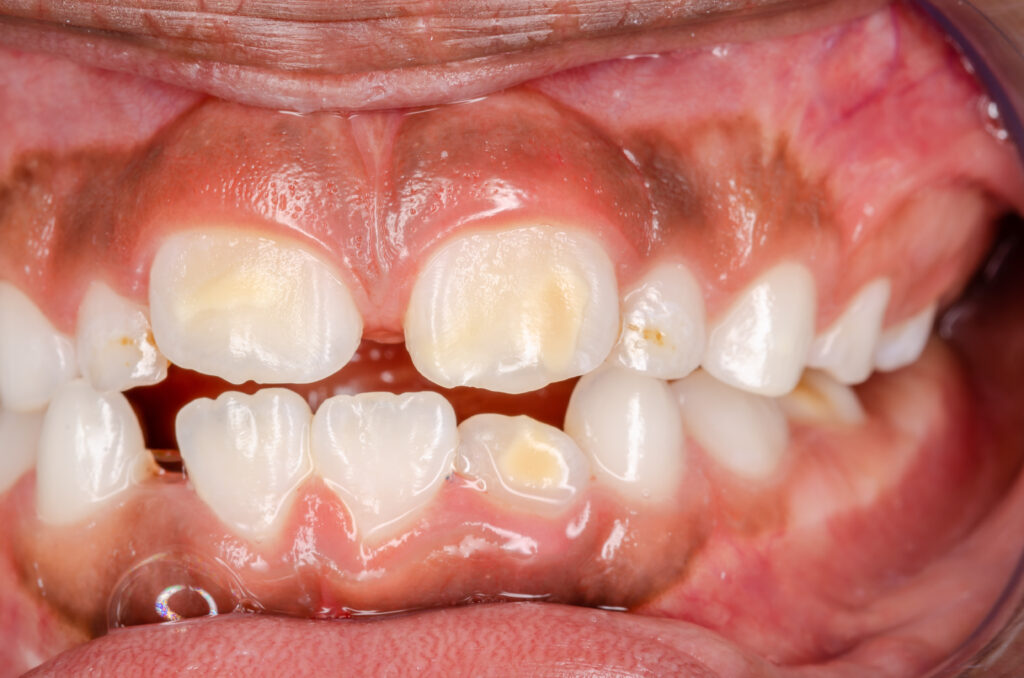 adobestock 452519857 1024x678 adobestock 452519857 1024x678 MIH - Taches blanches et jaunes Dentistes Essonne | Apolline Dental Care