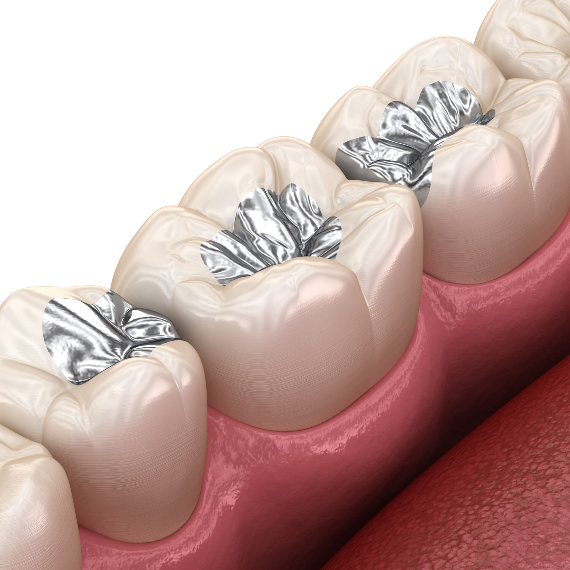 Ancien plombage au mercure (amalgame dentaire) remplacé par un matériau esthétique à Apolline Dental Care à Corbeil-Essonnes
