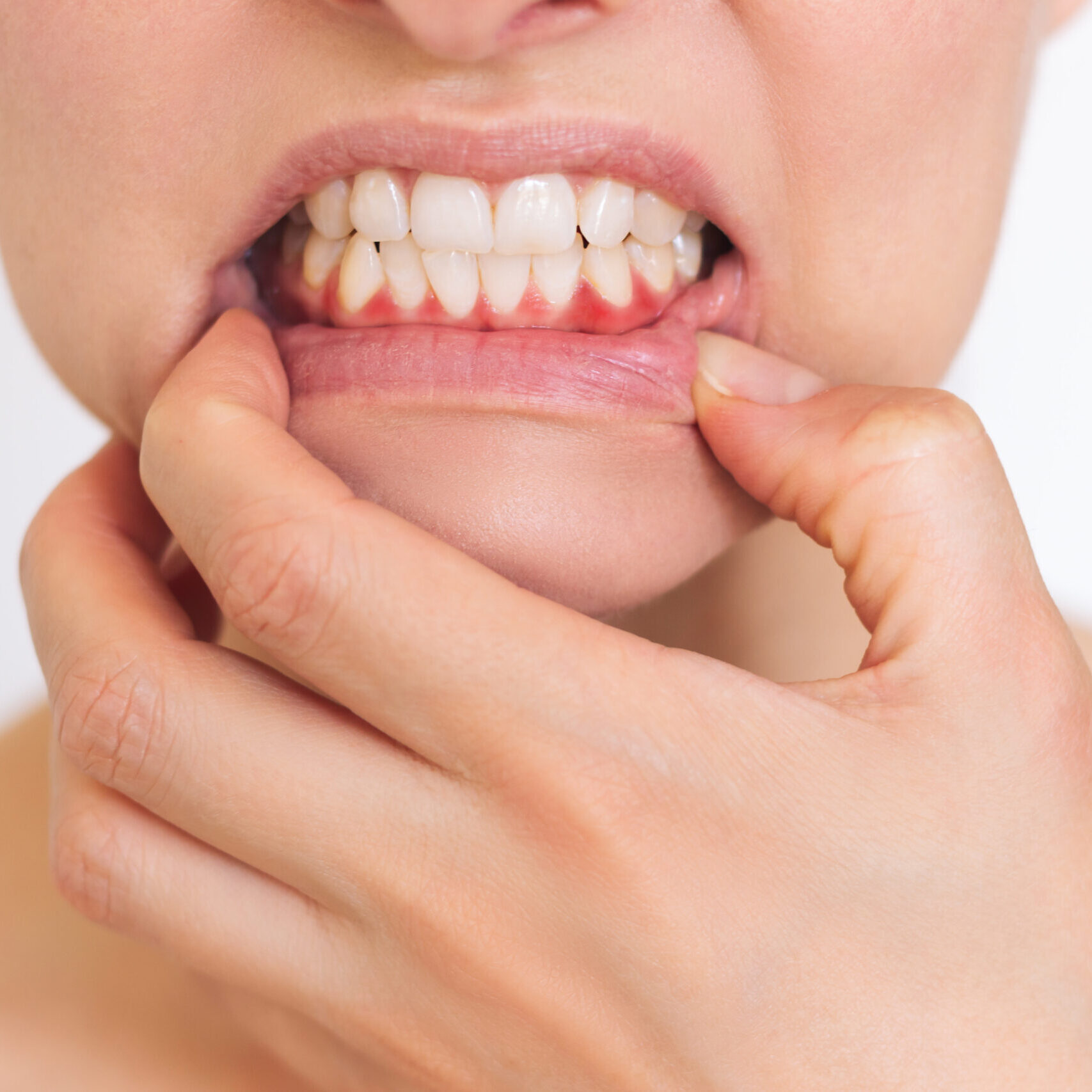 Soins parodontaux professionnels pour traiter l’inflammation et protéger les gencives à Apolline Dental Care à Corbeil-Essonnes