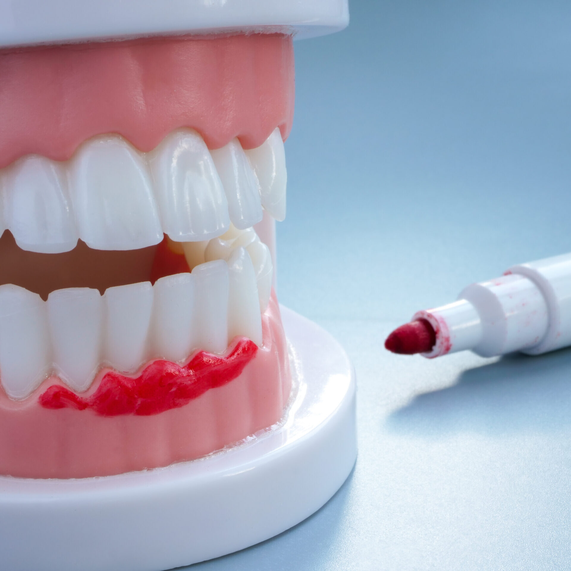 Greffe de gencive réalisée pour traiter une récession gingivale et protéger la racine dentaire à Apolline Dental Care à Corbeil-Essonnes