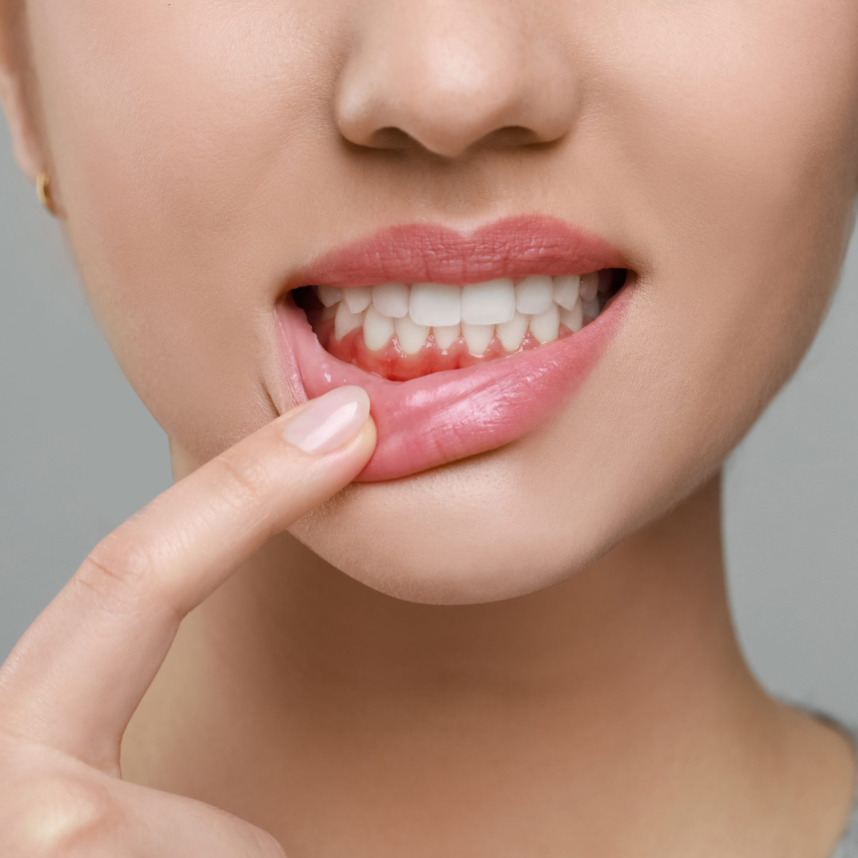 Séance de maintenance parodontale pour prévenir la récidive de la maladie des gencives à Apolline Dental Care à Corbeil-Essonnes