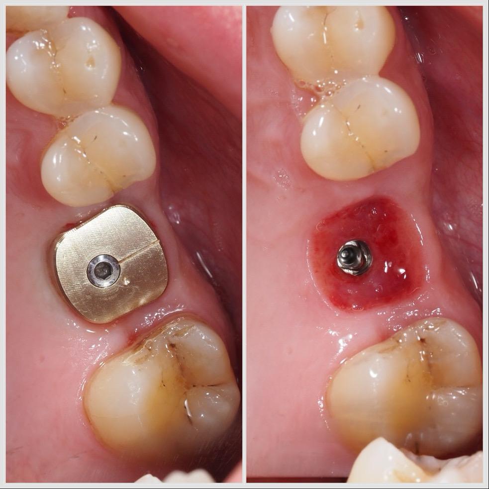 Implant posé avec la technique SSA Sealing Socket Abutment pour sceller le site d’extraction et préserver les tissus à Apolline Dental Care à Corbeil-Essonnes