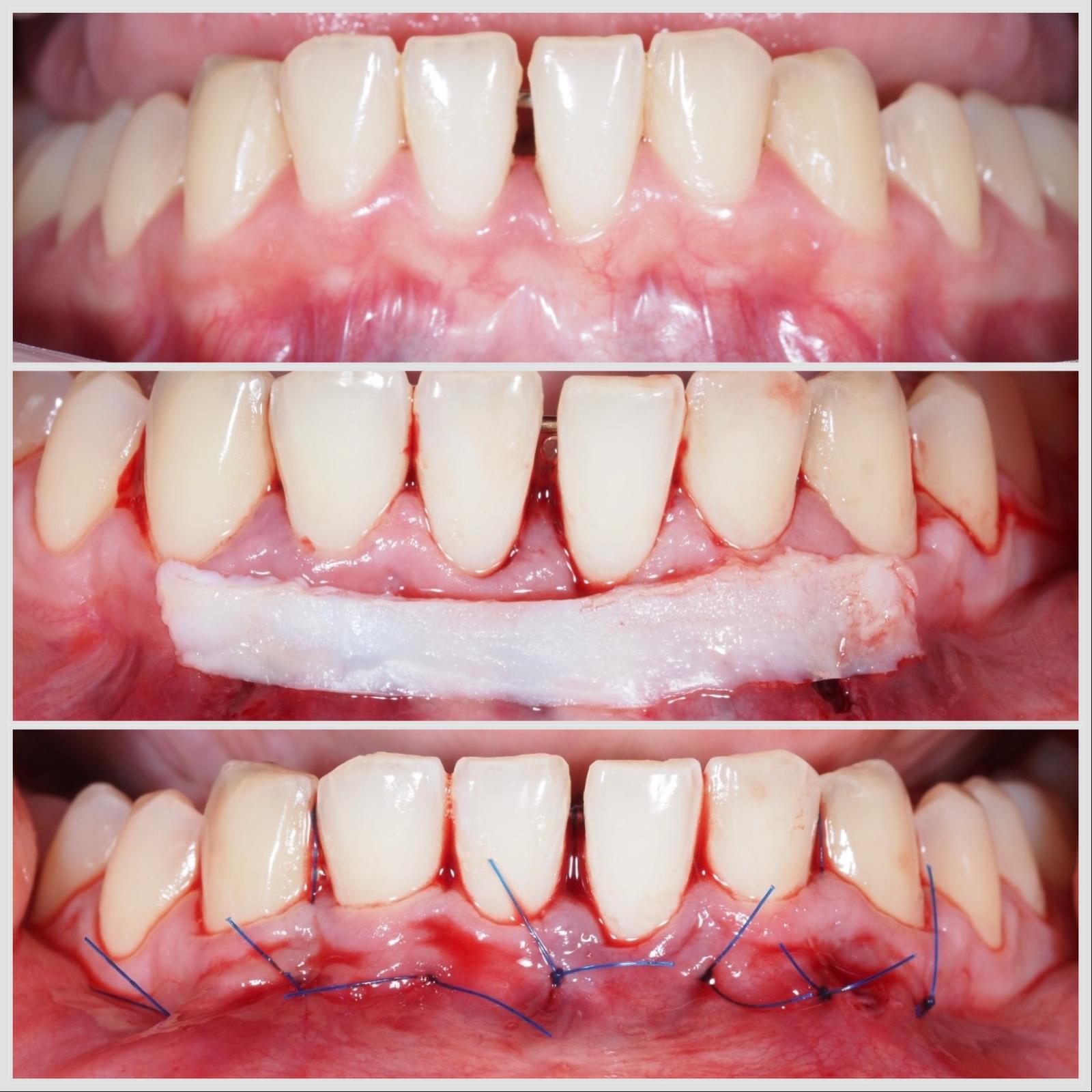 Greffe conjonctive réalisée par tunnel mandibulaire pour régénération naturelle des gencives à Apolline Dental Care à Corbeil-Essonnes