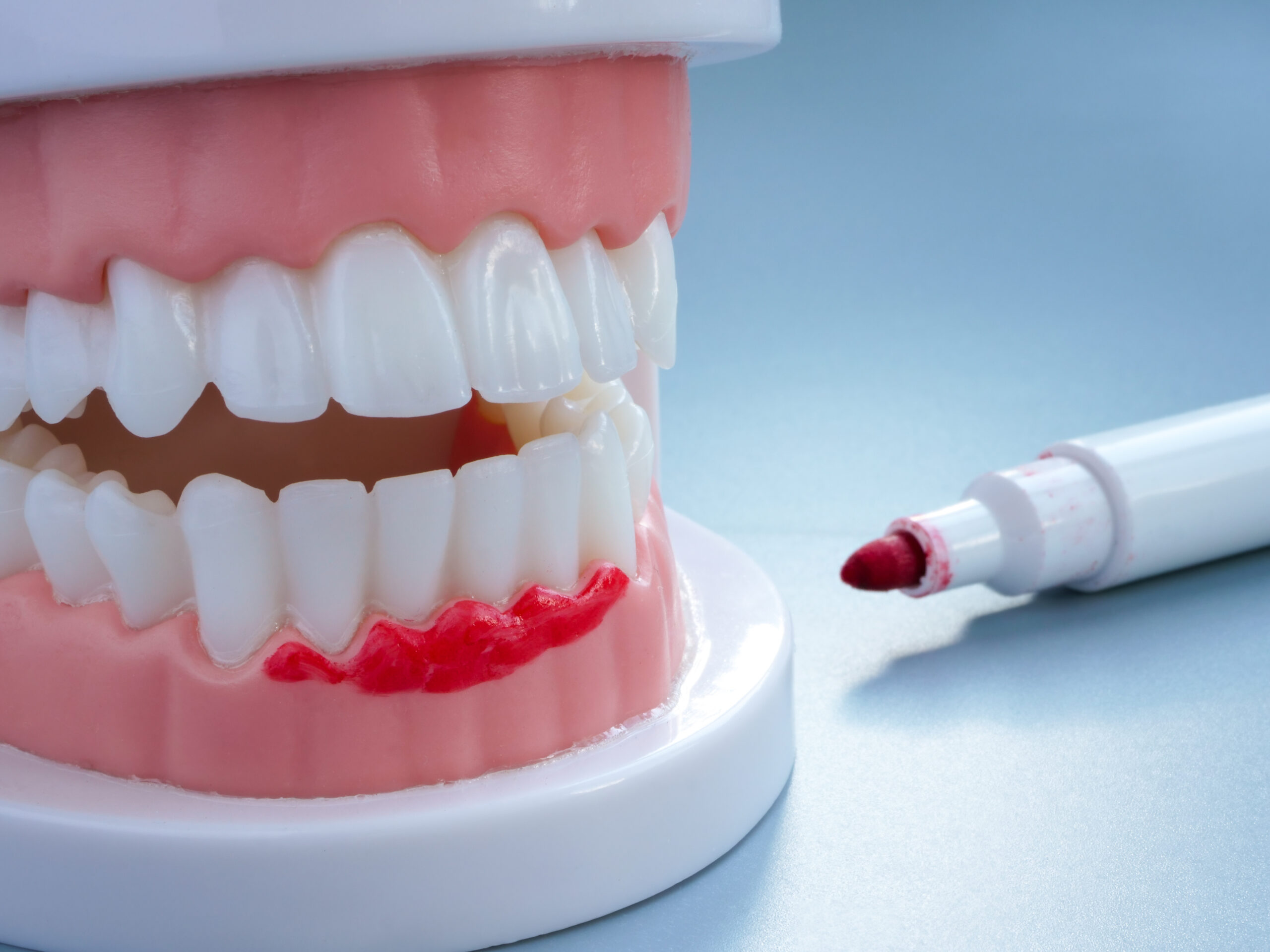 dentiste consultation dentaire complete scaled Greffe de gencive Apolline Dental Care | Cabinet Dentaire Spécialisé