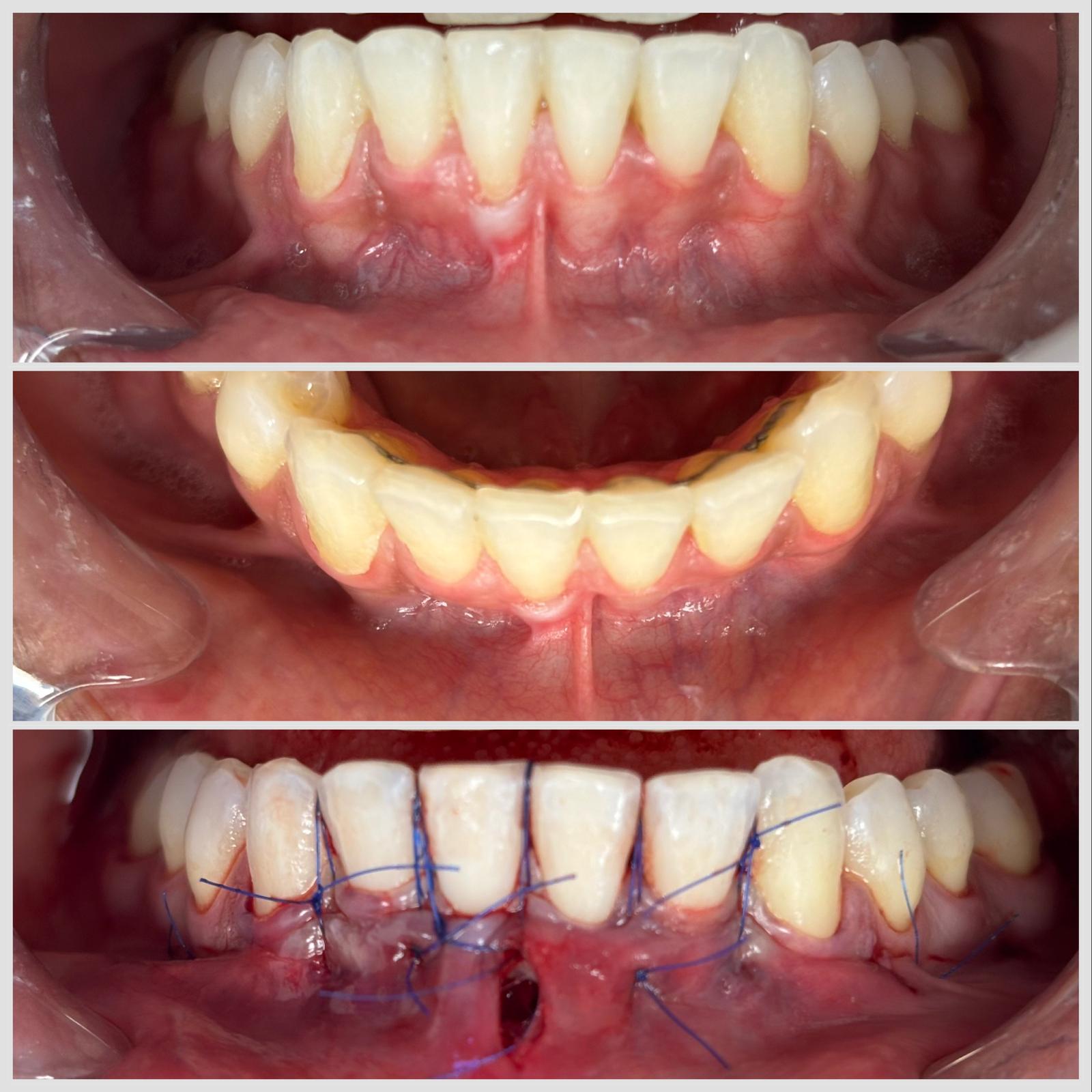Greffe conjonctive mandibulaire réalisée par technique tunnelisée pour traiter une récession gingivale à Apolline Dental Care à Corbeil-Essonnes