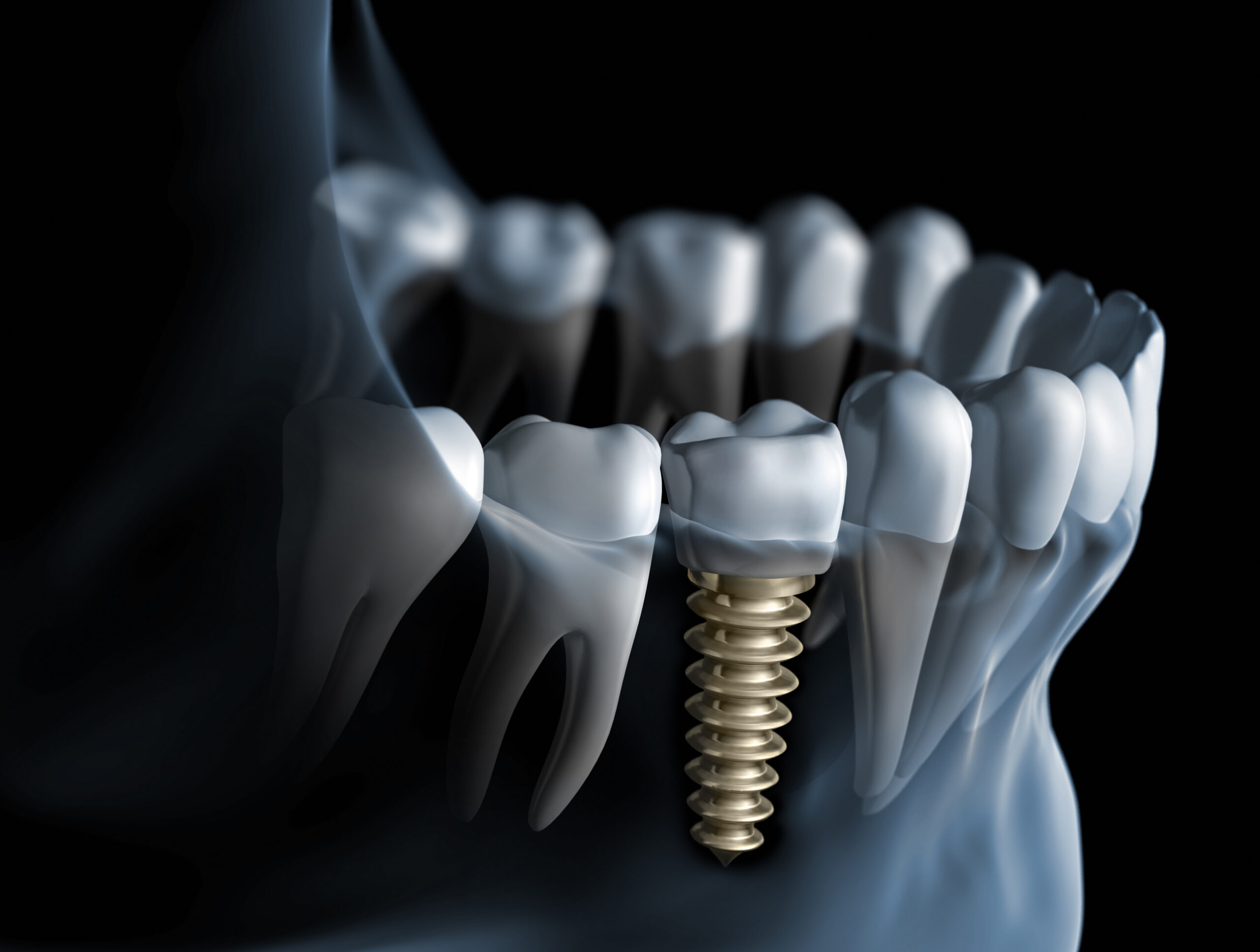 implant dentaire integration osseuse fiable scaled Contrôle post-opératoire de l'implant dentaire Apolline Dental Care | Cabinet Dentaire Spécialisé